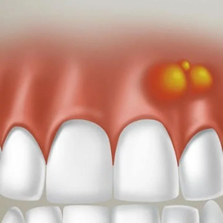 gnoinoe-vospalenie-d-3